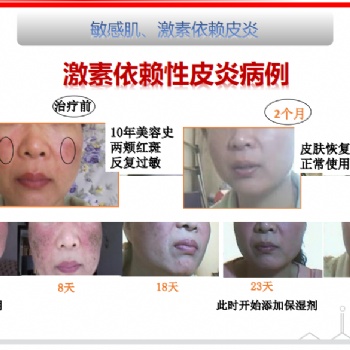 得了激素臉怎么辦:正確對待戒斷反應(yīng)，廣州怡嘉生物科技