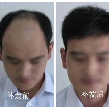 南陽中老年脫發少發人群定制假發，選專業機構就對了